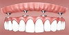 dental implant